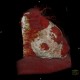 Constrictive pericarditis, VRT: CT - Computed tomography